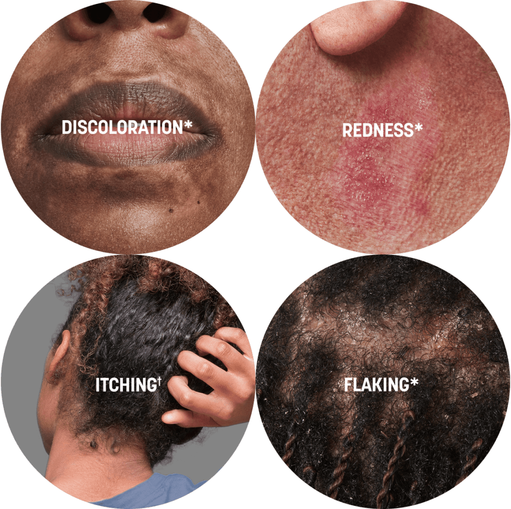 Arcutis blog symptoms circles image